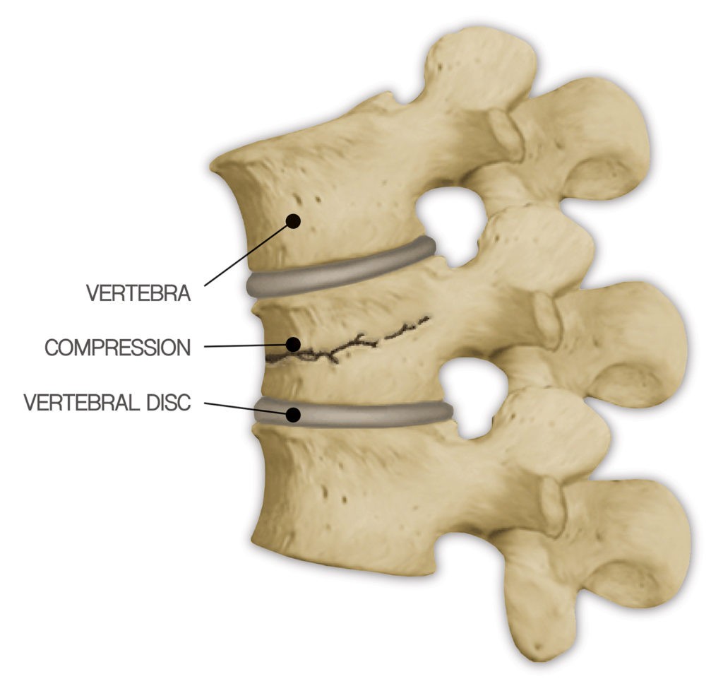 t12 compression fracture