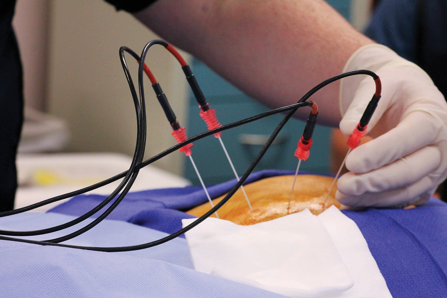 Radiofrequency Ablation Healthy Kansas City